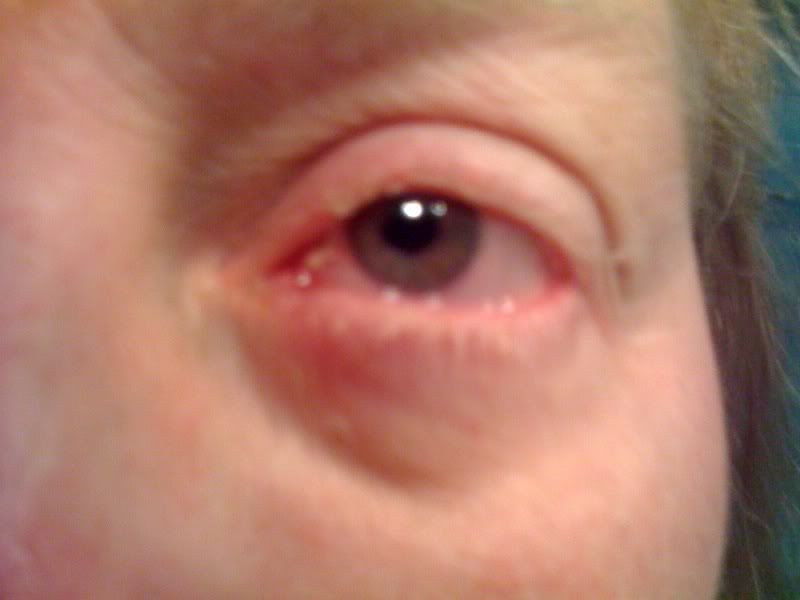 rood dik ooglid